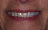 Closeup of Maureen's smile before dental treatment