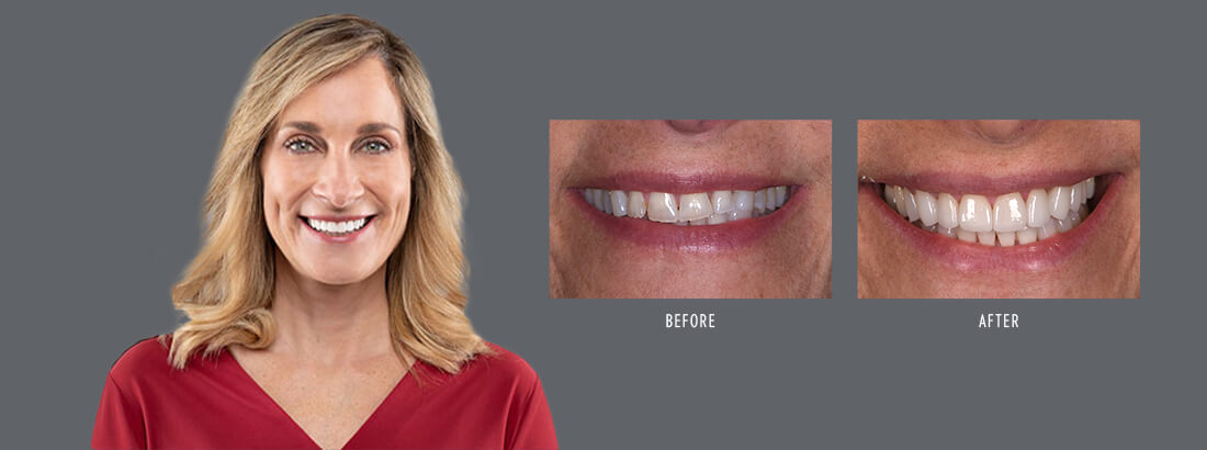 Jacksonville dental patient Maureen with before and after images of her smile