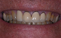 Closeup of stained teeth before dental treatment