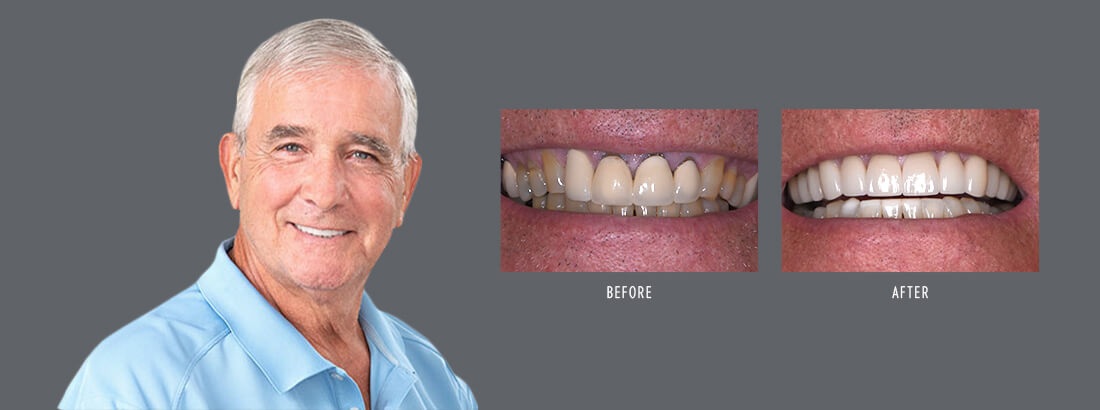 Jacksonville dental patient Woody with before and after images of his smile