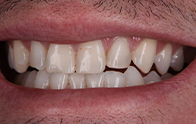 Closeup of crooked teeth before dental treatment