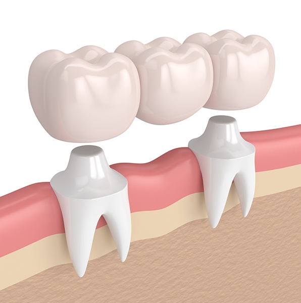 Animated smile during dental bridge placement