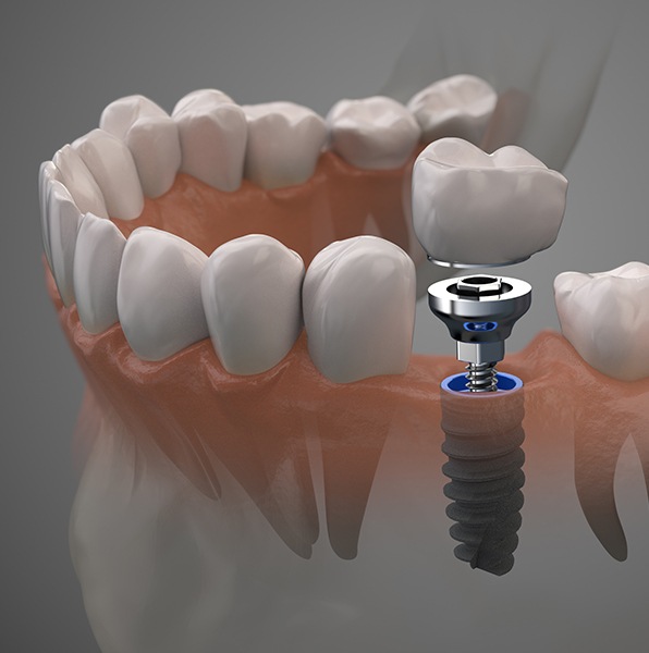 Animated smile during dental implant supported dental crown placement