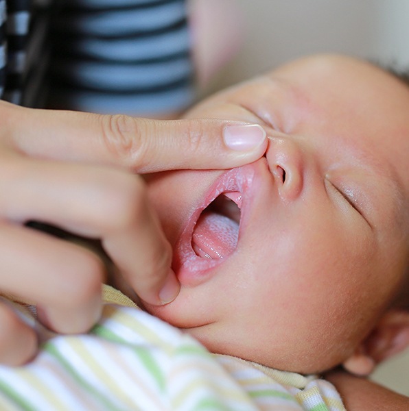 Dentist examining baby's smile after frenectomy for lip and tongue tie