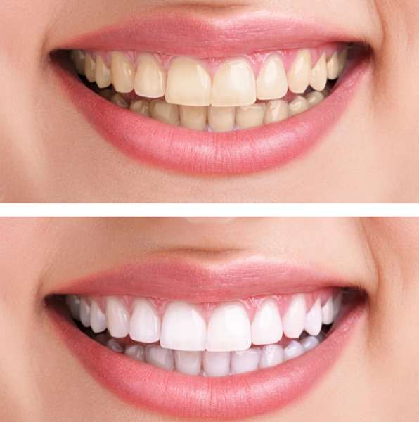 before and after teeth whitening photos