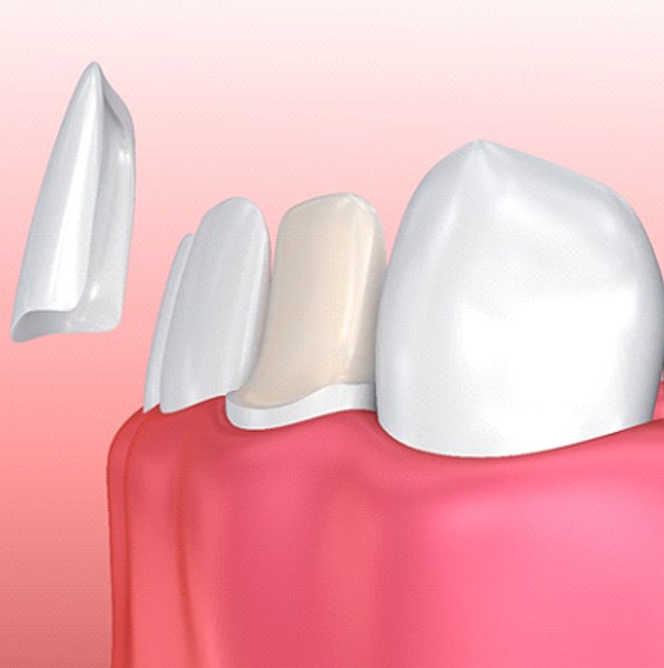 Diagram showing how porcelain veneers in Jacksonville work 