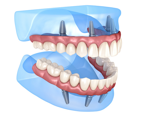 model of dentures supported by dental implants