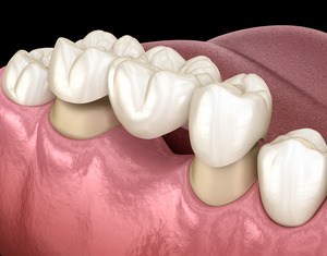 dental bridge in someone’s mouth