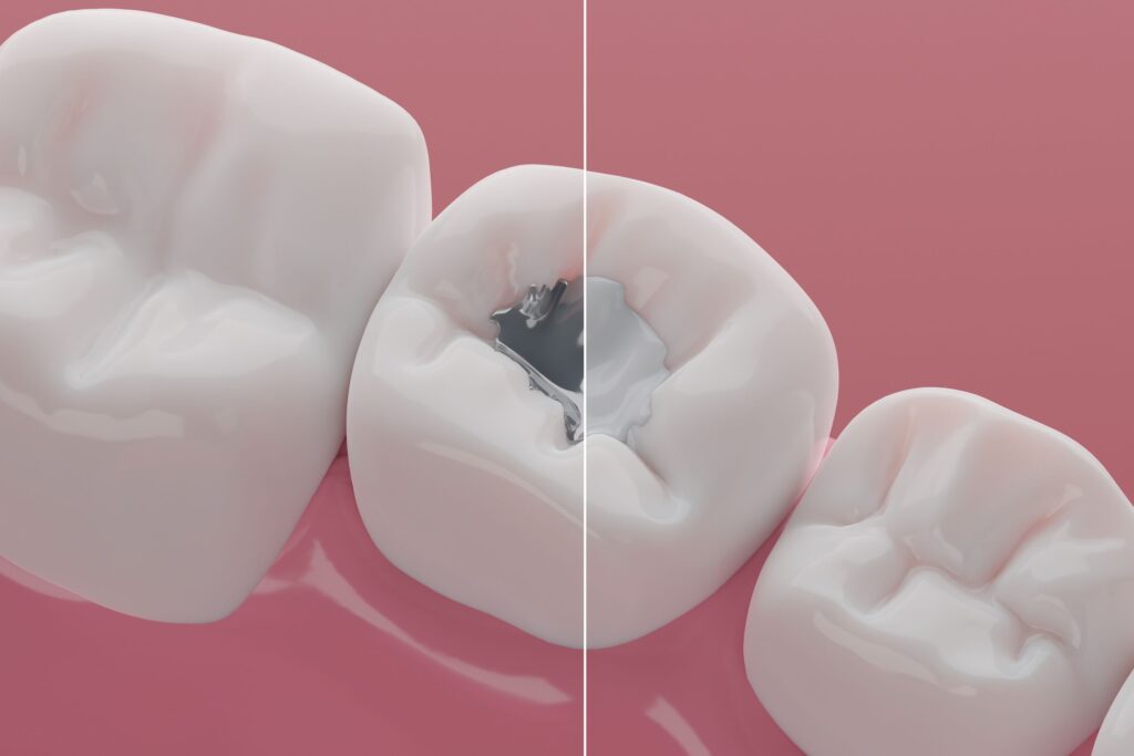 Illustration of tooth that's half filled with amalgam and half composite resin